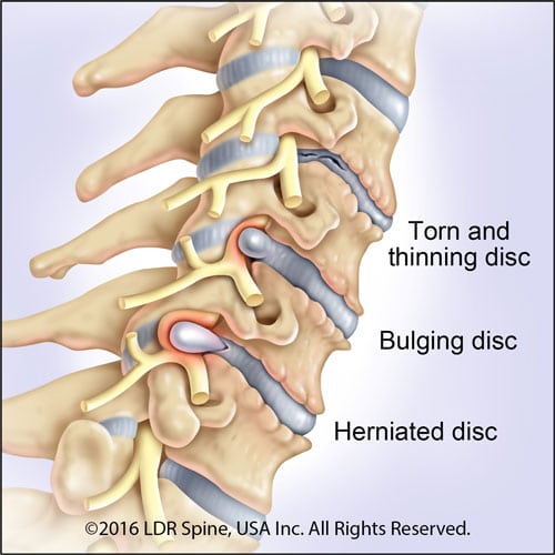 Graphic of the Cervical Spine